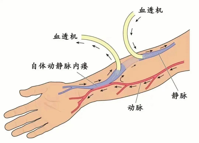 动静脉内瘘球囊扩张术开辟透析患者“生命通路”
